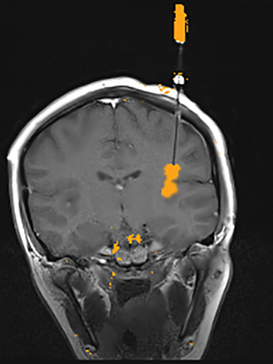 MRI showing laser ablation at area of seizure activity