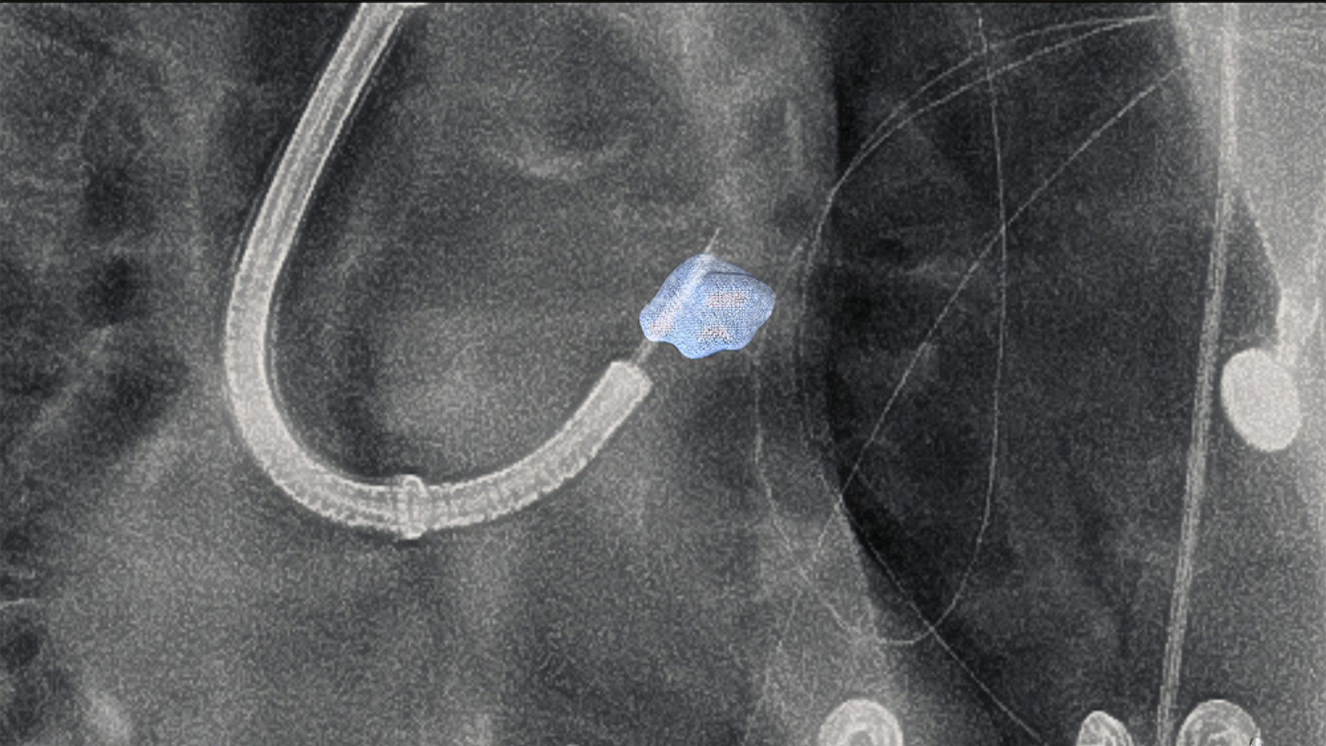 CT scan of lung demonstrating transthoracic needle approaching peripheral nodule