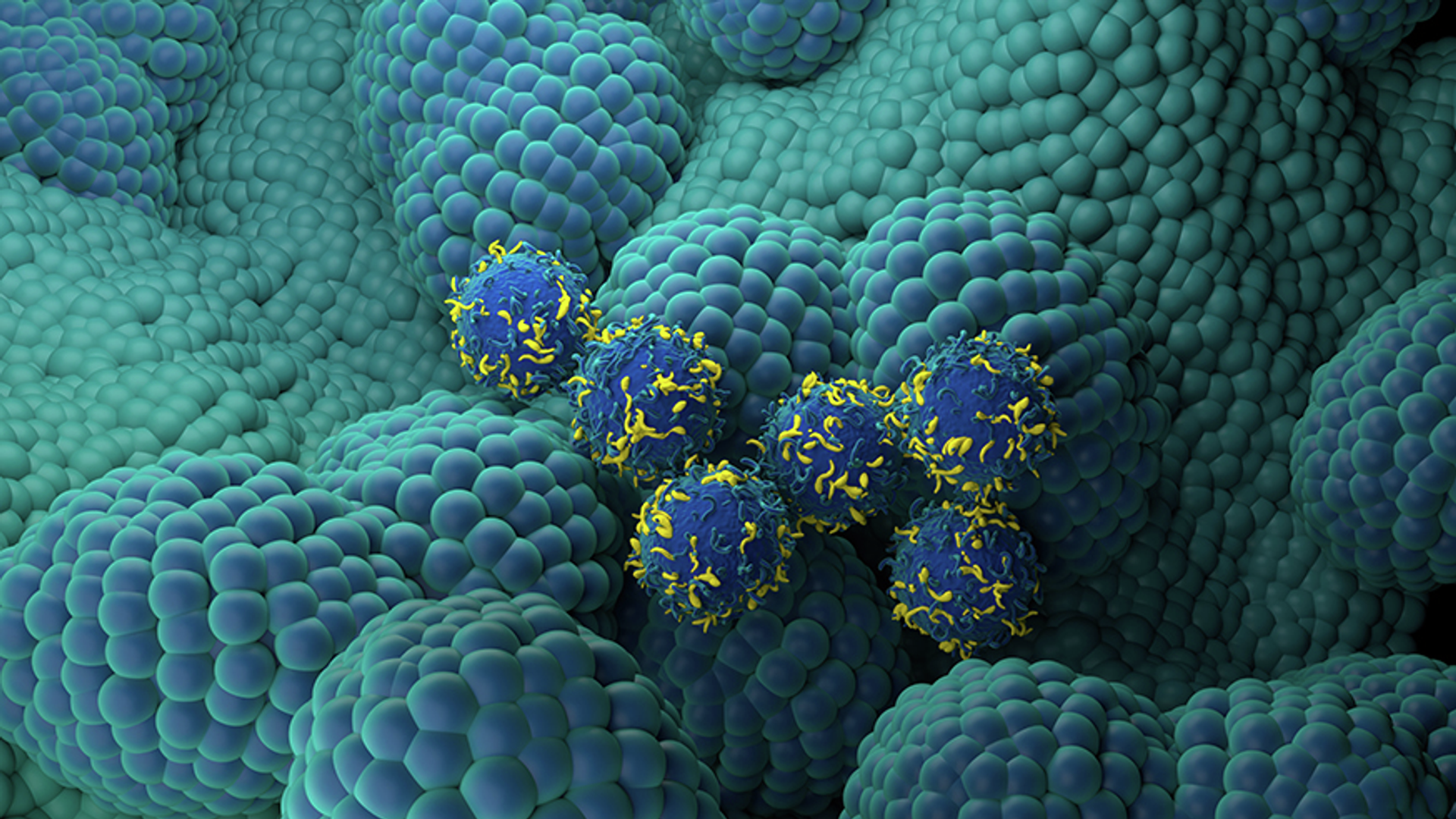 Illustration showing CAR T cells (blue and yellow) being used to treat prostate cancer (light blue, nodular).