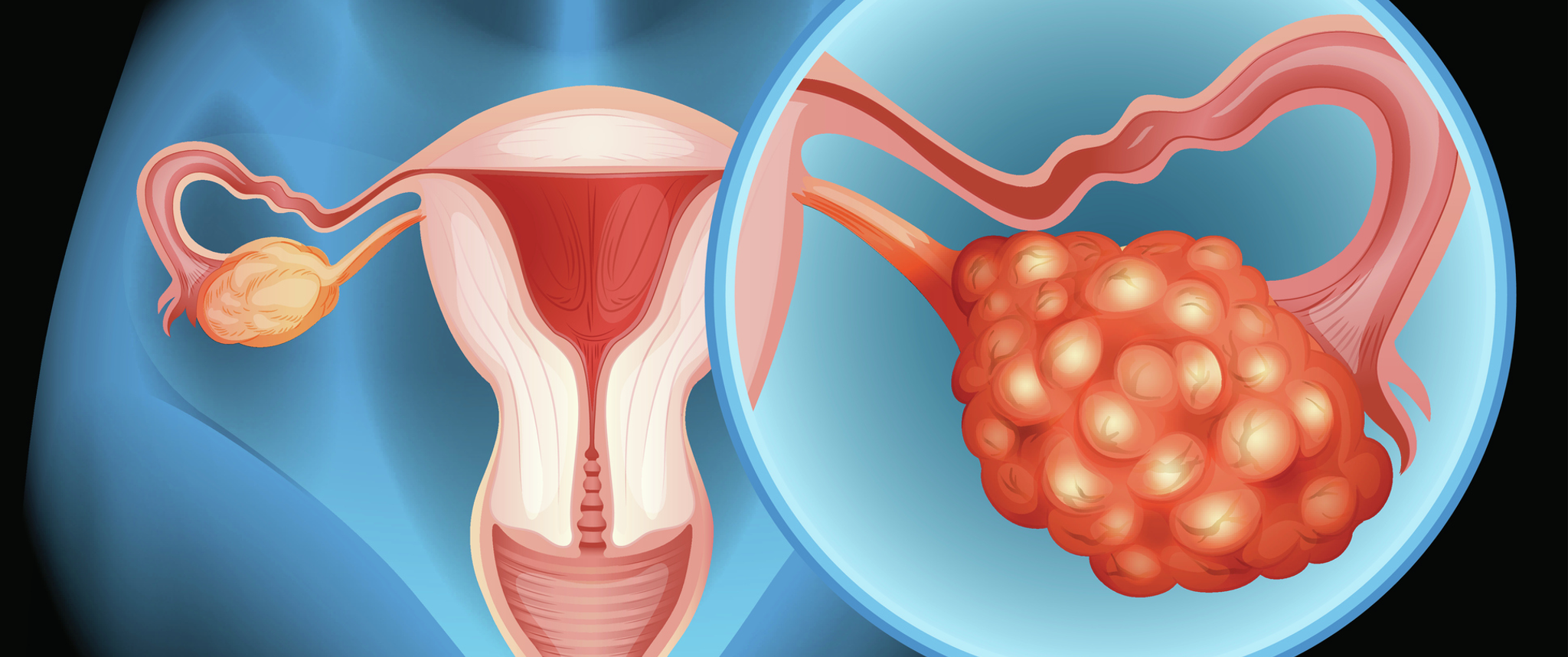 Ovarian cancer illustration