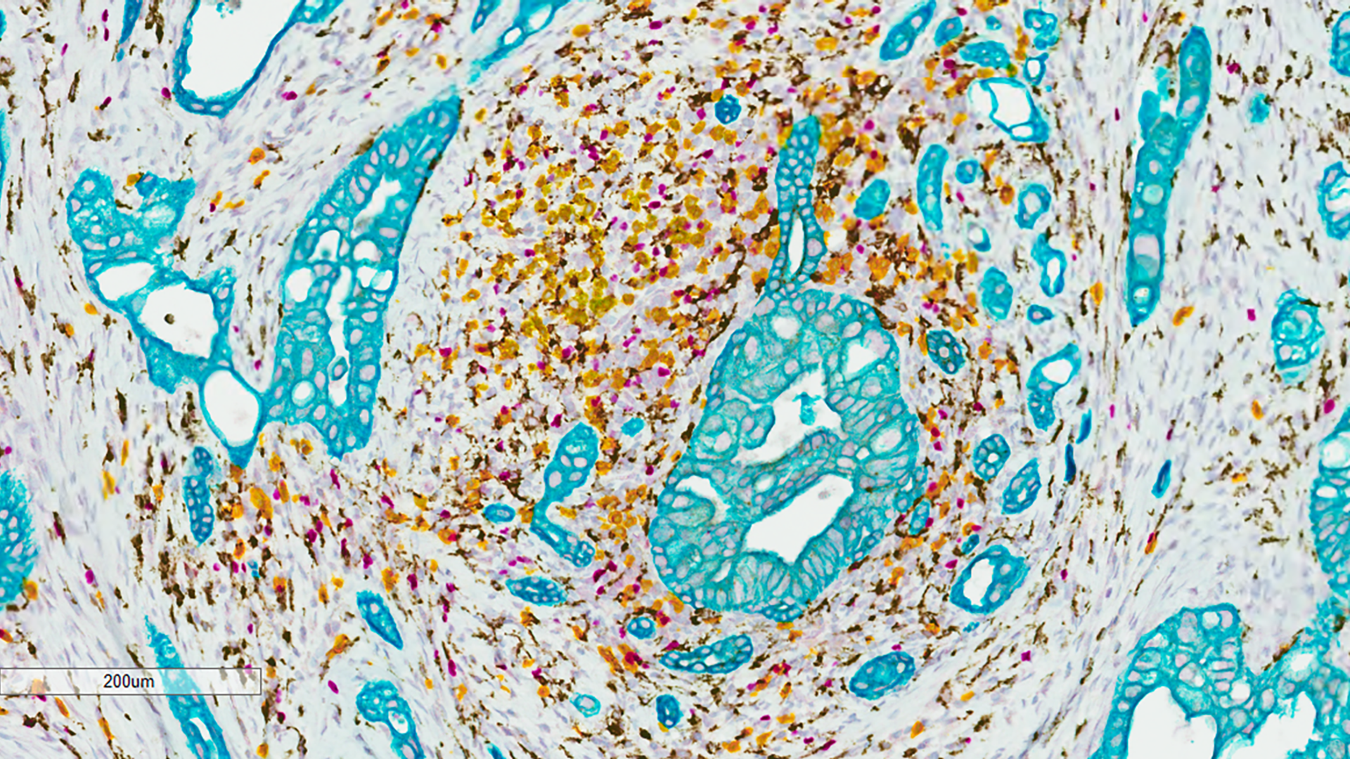 A microscopic image of pancreatic cancer cells showing distinct sections of cells and shapes in yellow-brown and bright teal and purple colors