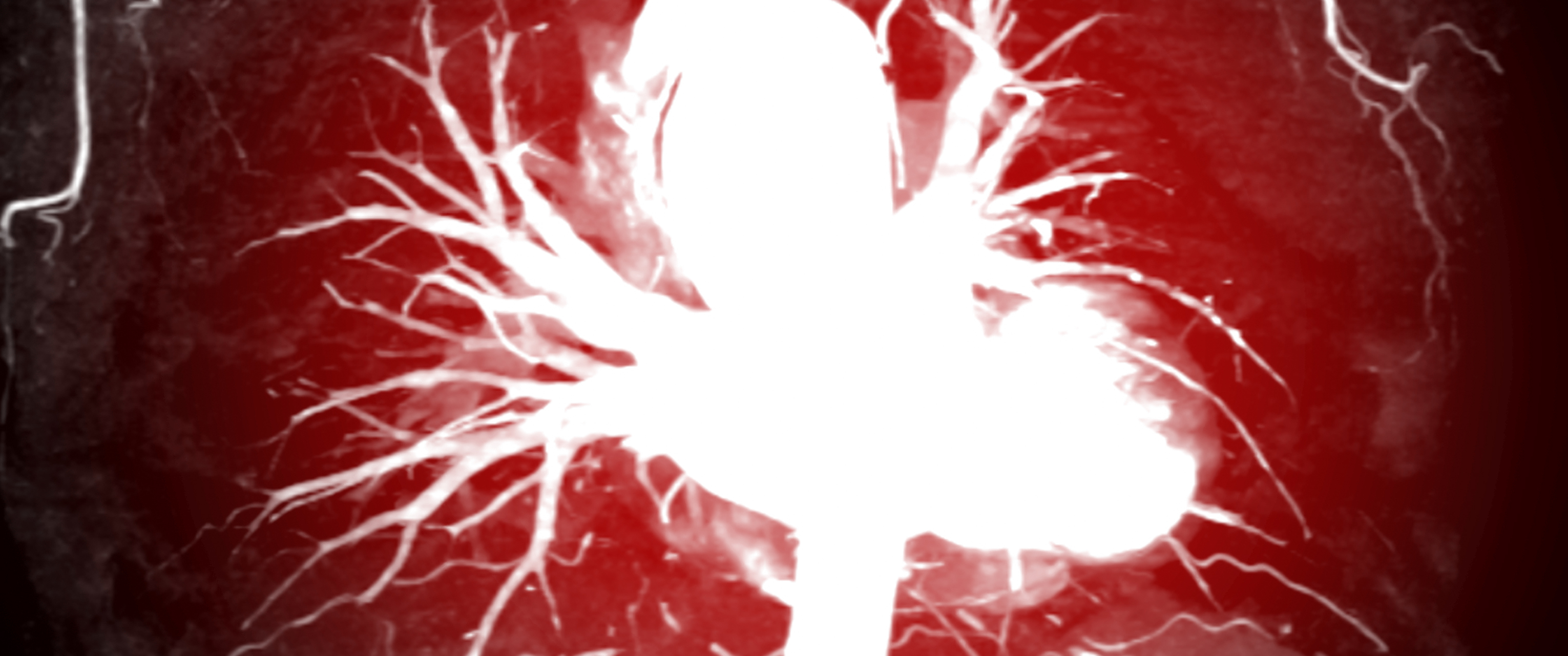 CTA thoracic aorta 3D rendering image with injection contrast media ( White ) into thoracic aorta for diagnosis aortic aneurysm.