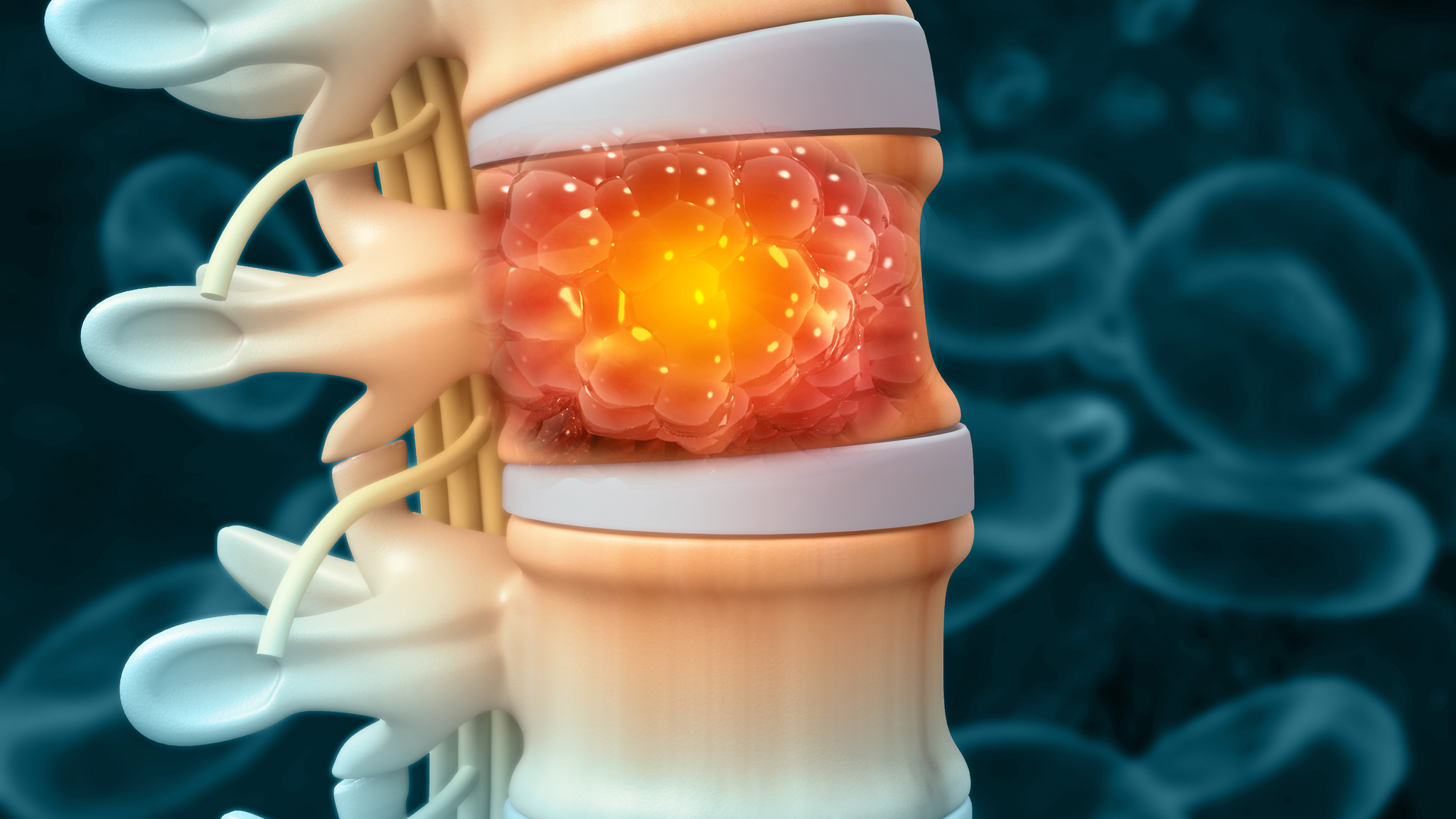 Spine cancer or spinal tumor disease.3d illustration