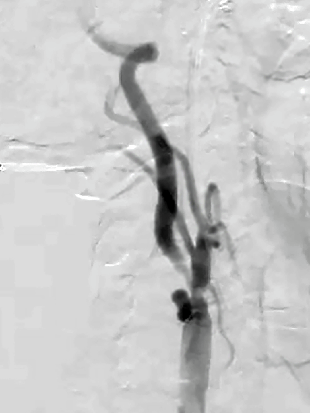 Blockage in internal carotid artery