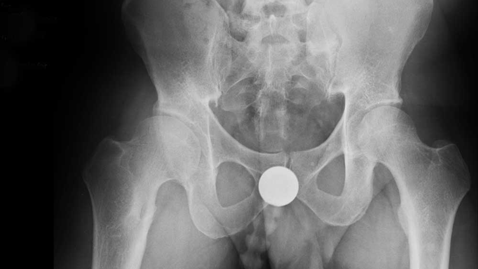 X-ray of hip