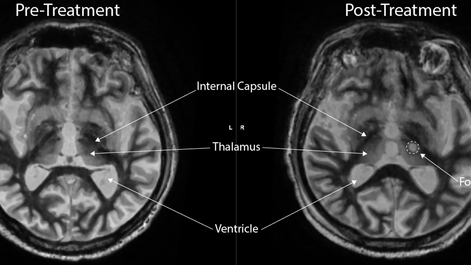 MRI scans of pre- and post-treatment