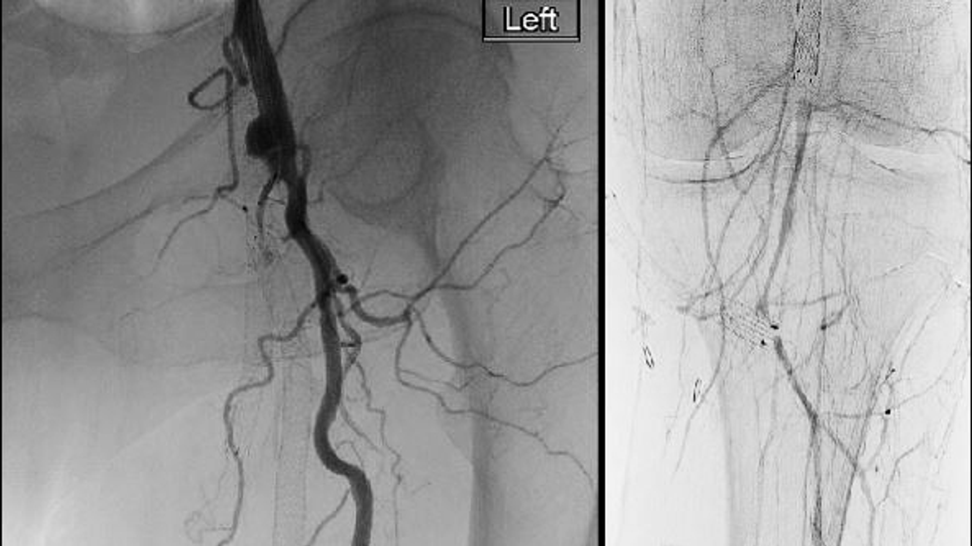 Two scans demonstrate the reduction in blood flow to the lower leg caused by a long clot in the femoral artery shown in detail in the left image