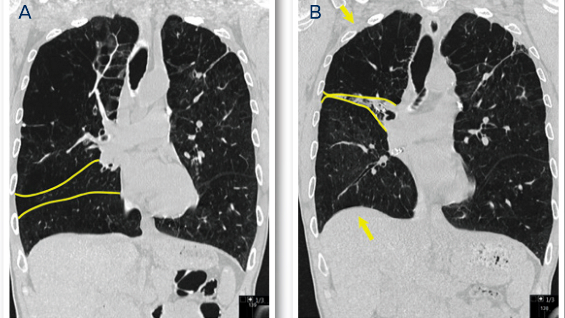 Side-by-side lung scans, labelled A and B, show the difference in lung shape before and after BLVR. Yellow outlines and arrows indicate the movement and decreased size of the lobes and diaphragm. 