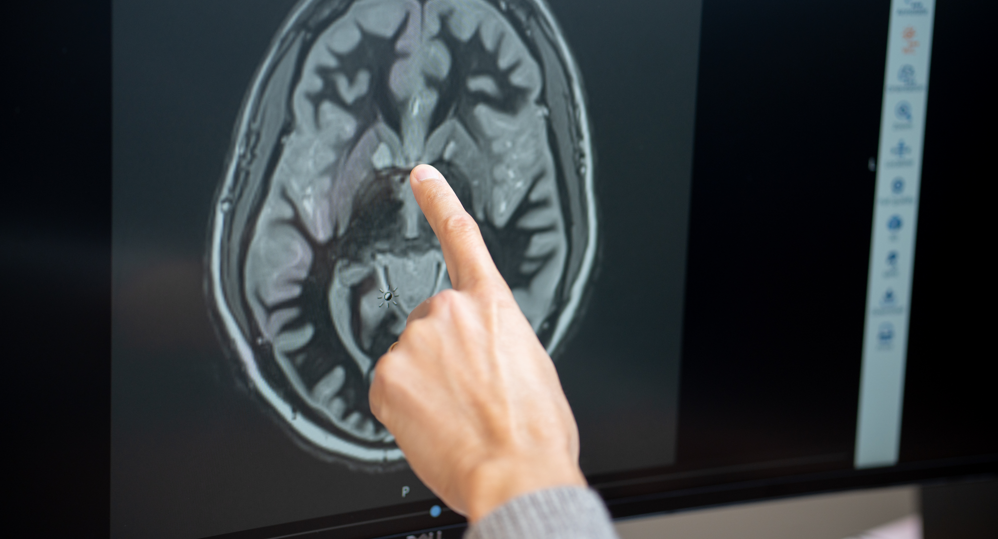 CT scan of human brain with doctor pointing at the structure in the center
