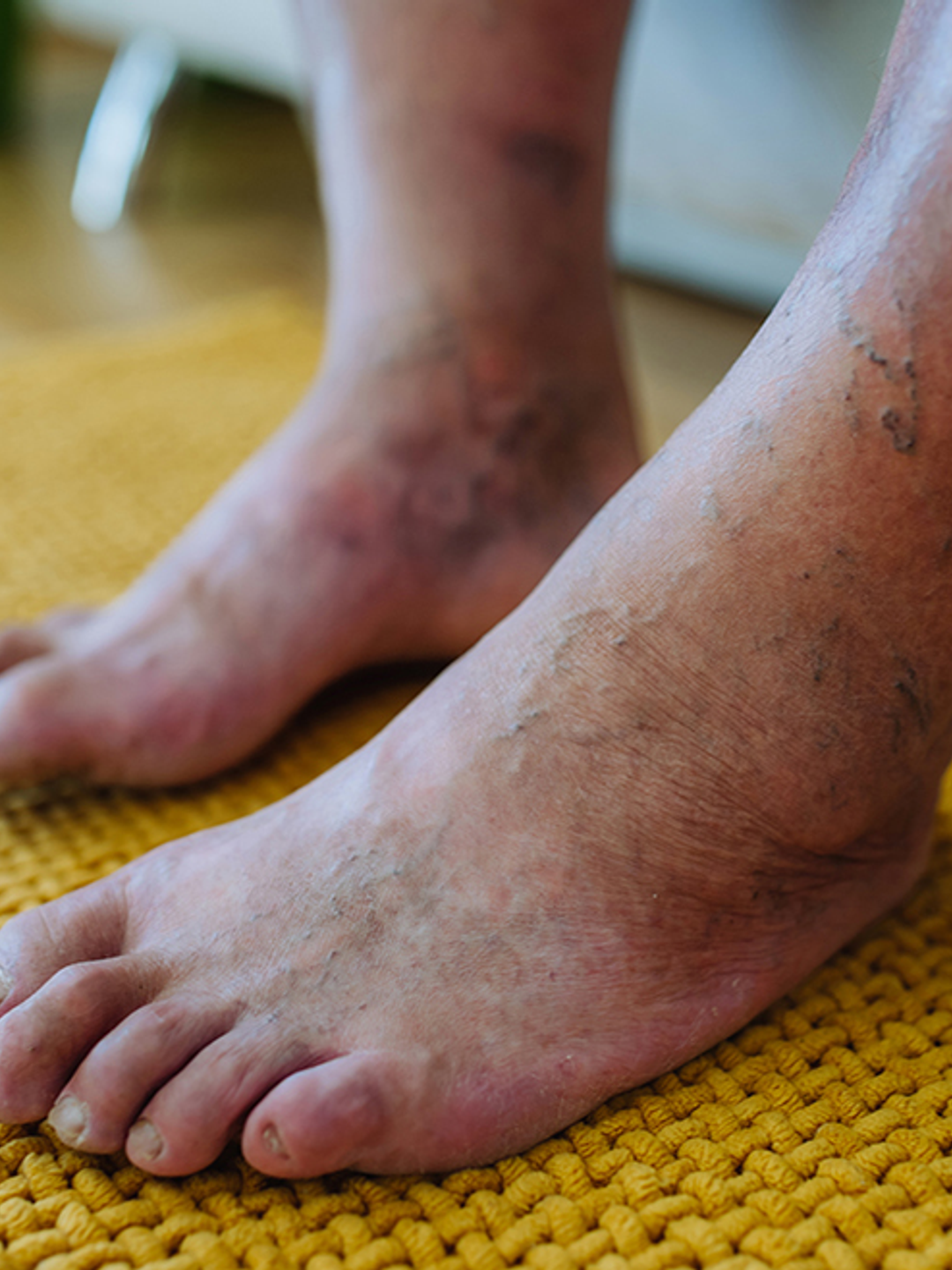 The feet of an individual with PAD are shown