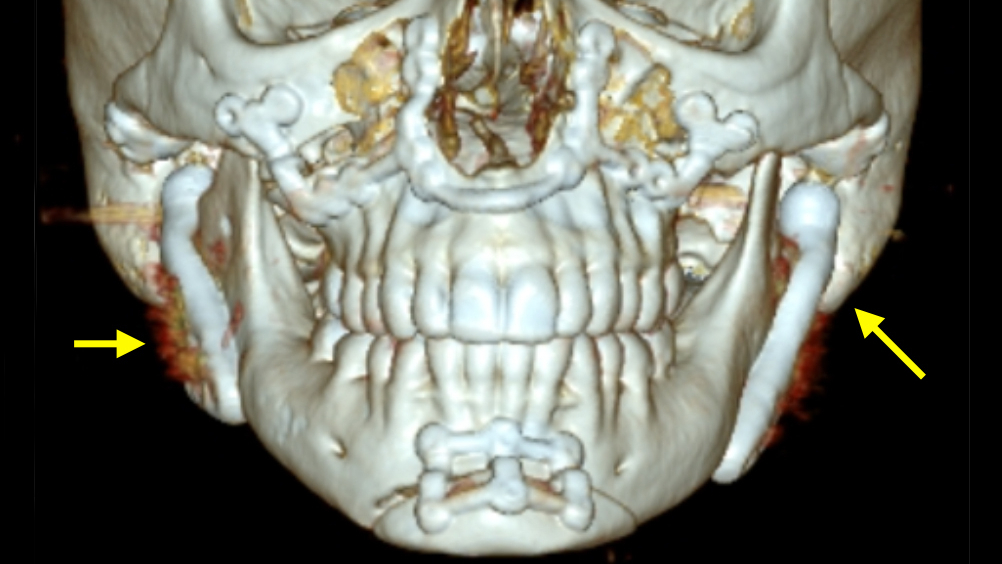 A skull is shown in three dimensions demonstrating correction of lower facial deformity by TMJ replacement (arrows) and realignment of lower jaw