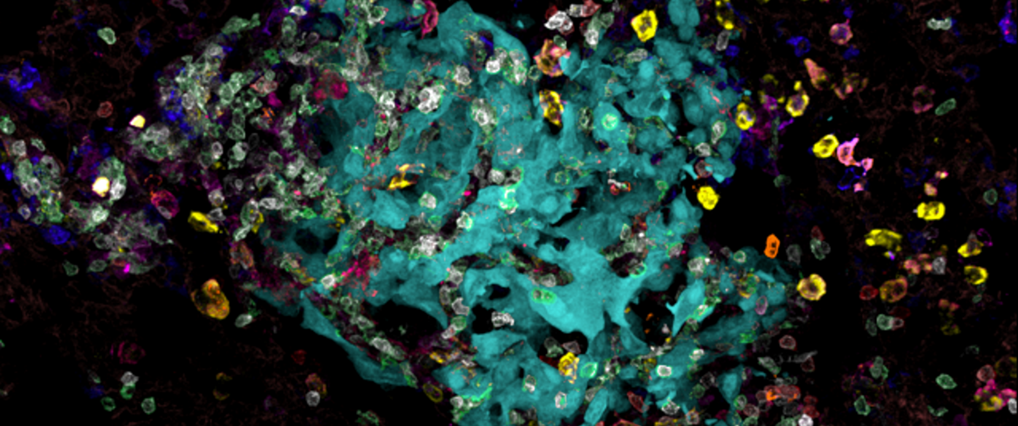 A confocal microscopy of the lung tumor microenvironment with cyan-colored developing lung tumor cells with other myeloid cells surrounding them.