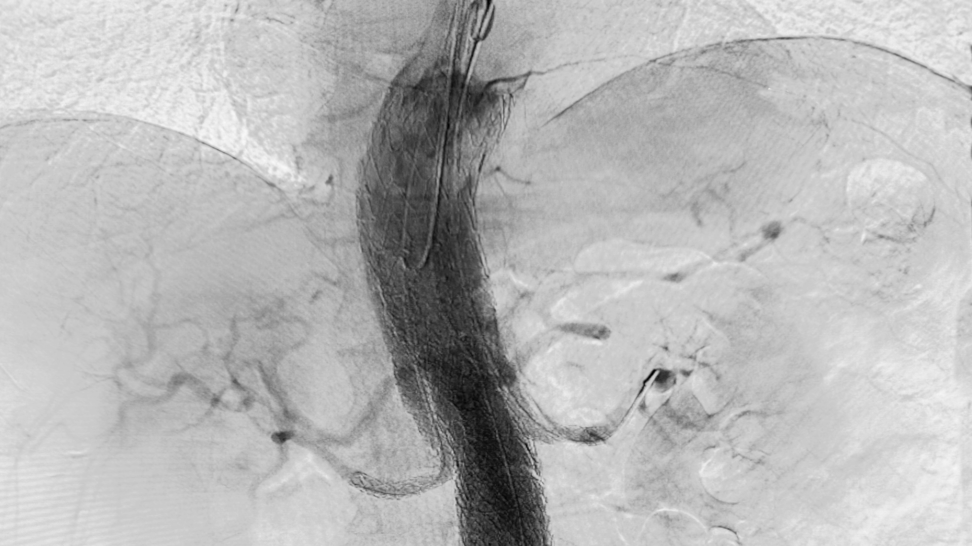 The TAMBE system at the conclusion of surgery; no endoleaks or other issues occurred.