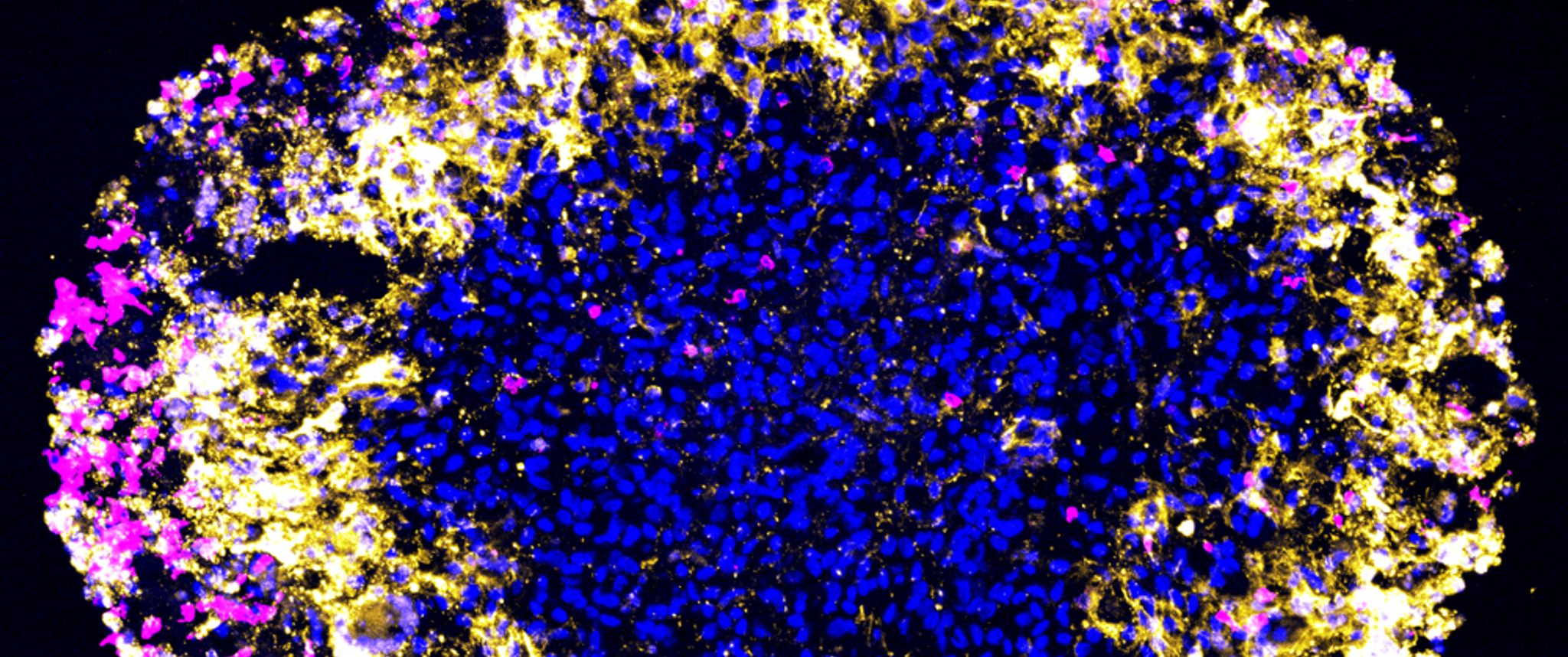 A patient-derived glioblastoma organoid treated with dual-target CAR-T cells