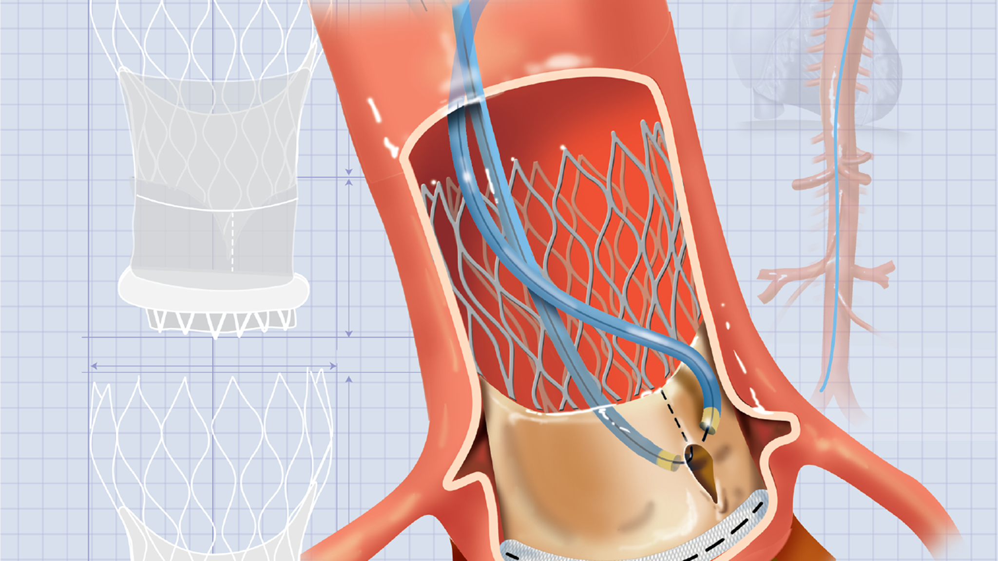 percutaneous electrocautery knife lacerating an aortic valve leaflet during BASILICA procedure