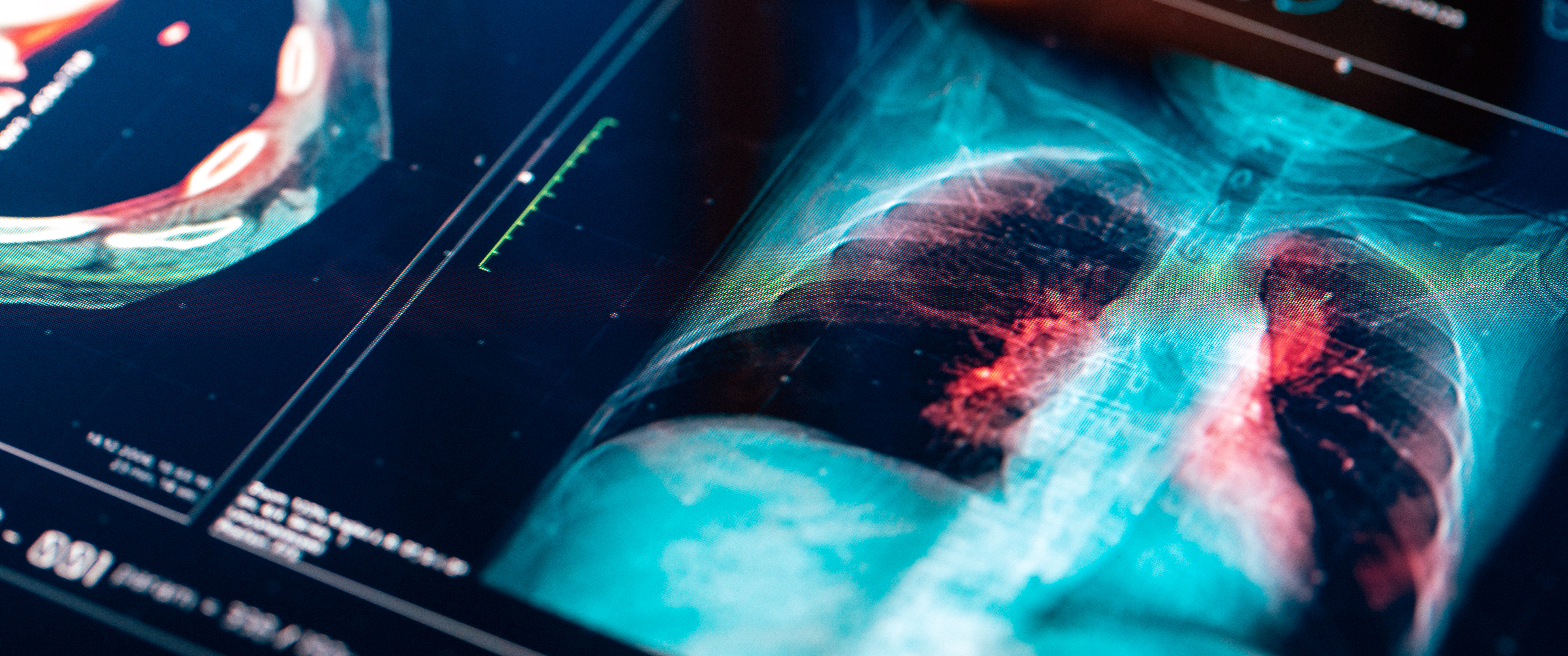 A MRI scan of the lungs on a digital screen