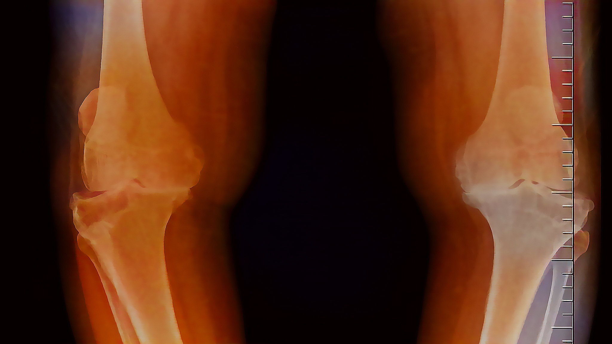 AP projection of both knees reveals findings suggestive of Grade 4 osteoarthritis.