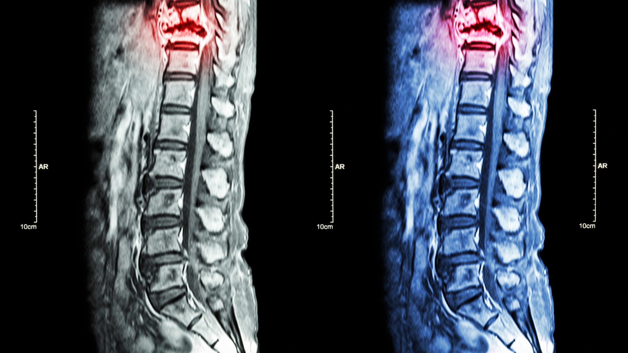 An MRI of metastasis in the spine