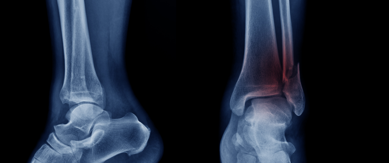 Stem cell discovery could be key to healing tough-to-fix fractures Stem cell discovery could be key to healing tough-to-fix fractures