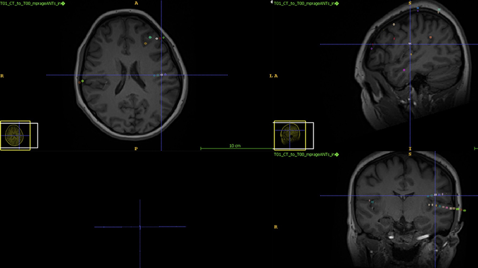 StereoEEG electrodes placed to identify the location of seizures