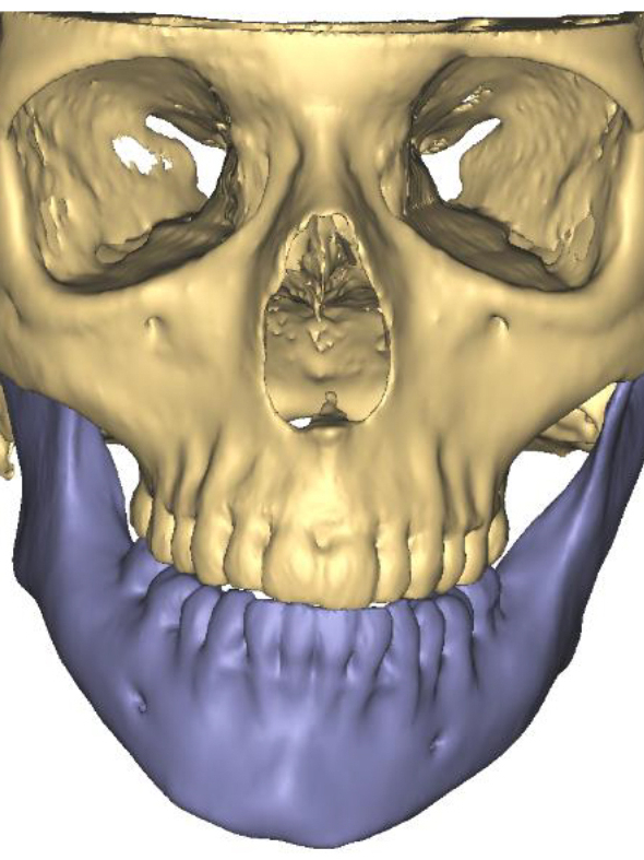 A skull is shown in three dimensions with lower facial deformity (in blue) showing offset of jaw and chin