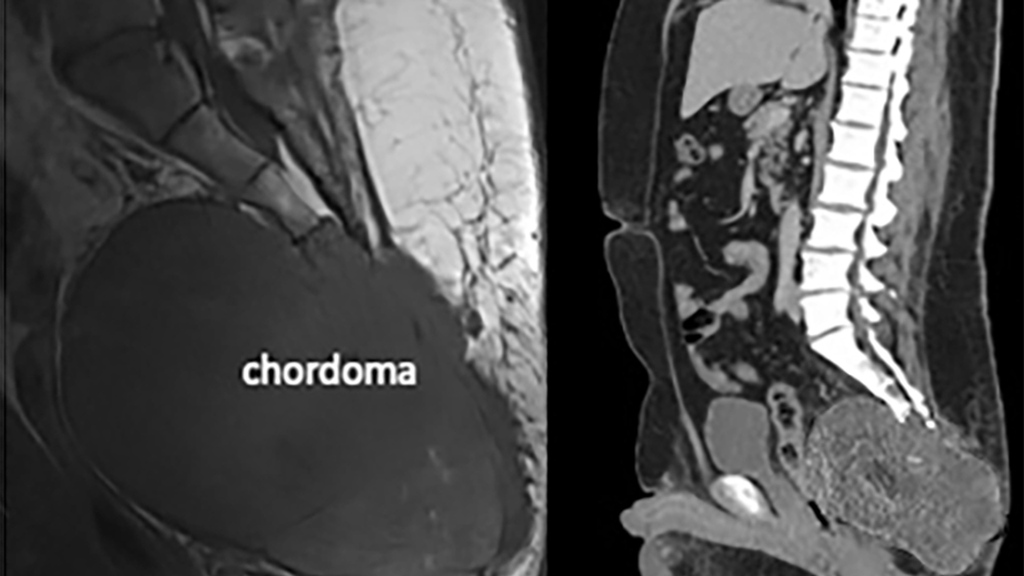 Imaging of a large sacral chordoma