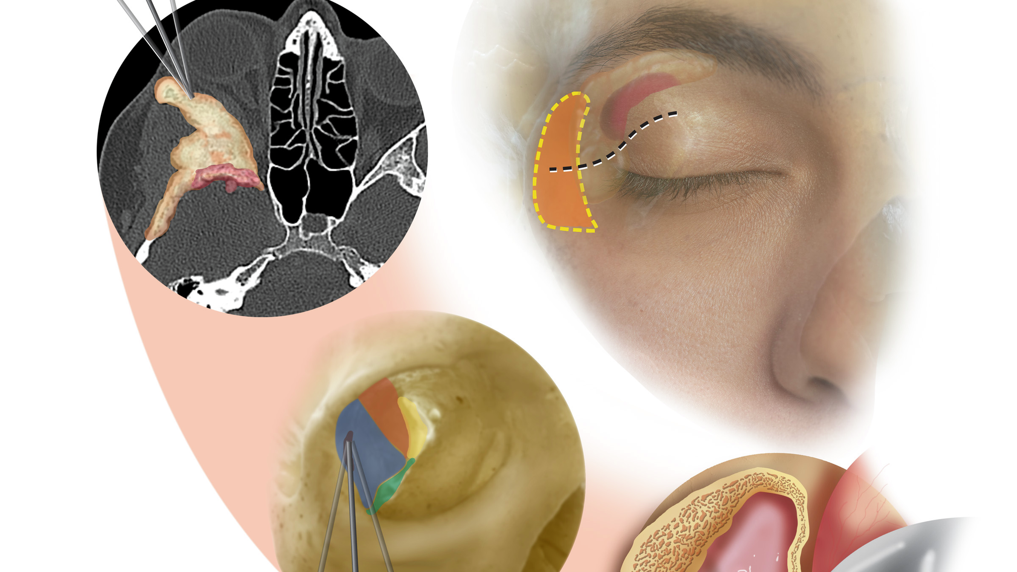 illustration of the transorbital approach to brain surgery
