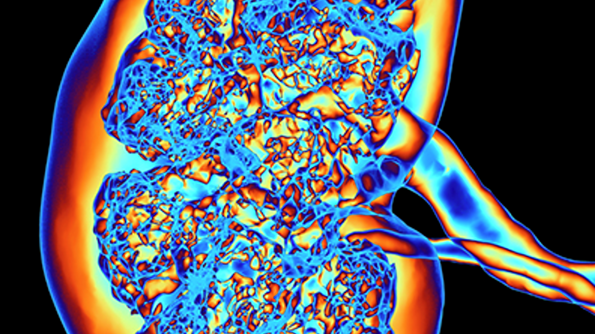 Kidney, CT scan. False colour 3-D computed tomography (CT) scan of a kidney in frontal view.
