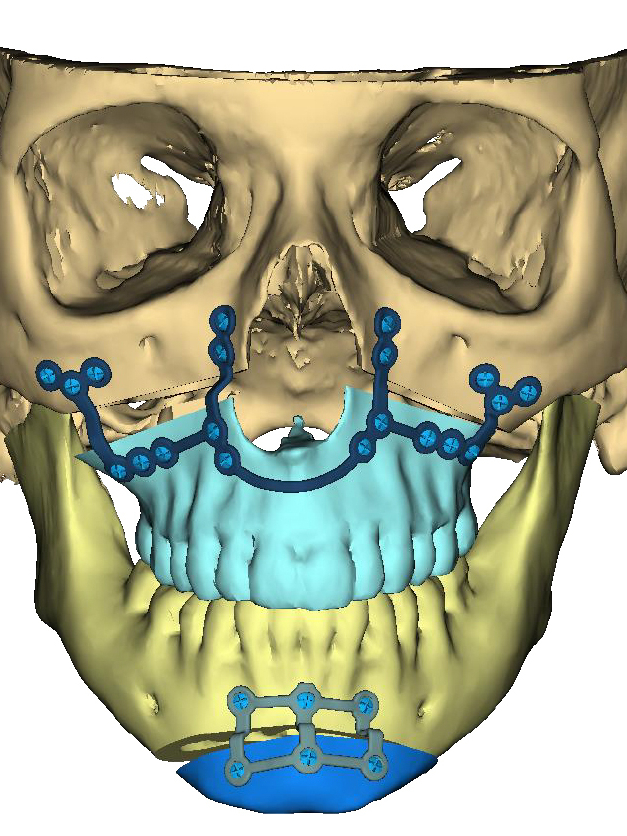 A skull is shown in three dimensions with planned indications for future surgery to realign jaw and chin
