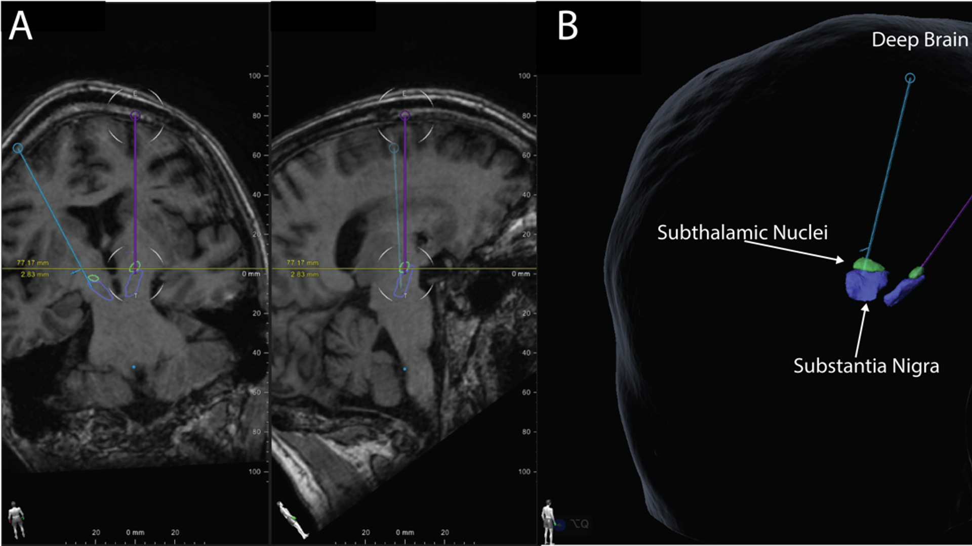3D view of deep brain stimulation electrodes in brain