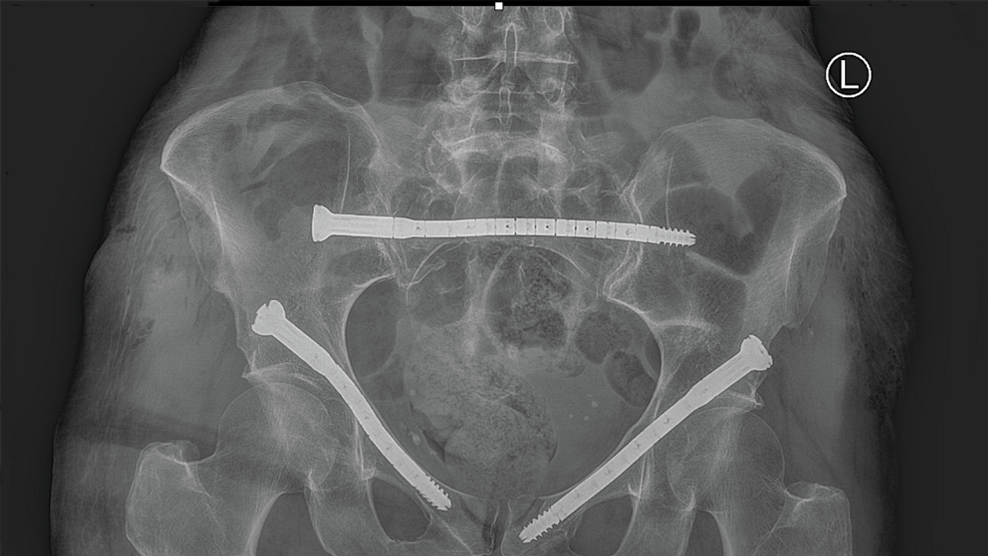 An X-ray of a fractured pelvis shows CURVAFIX screws holding the broken pieces together