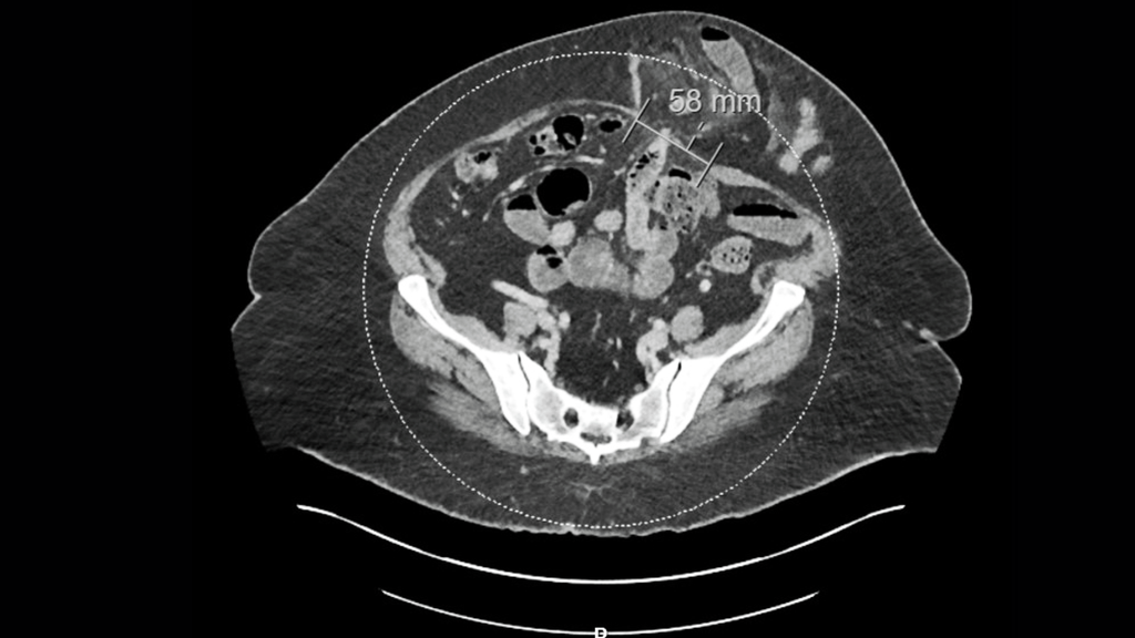 CT scan showing a large recurrent ventral hernia containing multiple loops of bowel