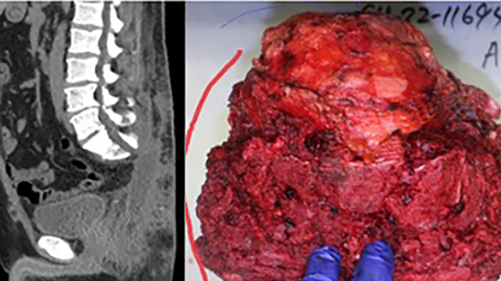 CT of spine following tumor resection with photo of 8" tumor