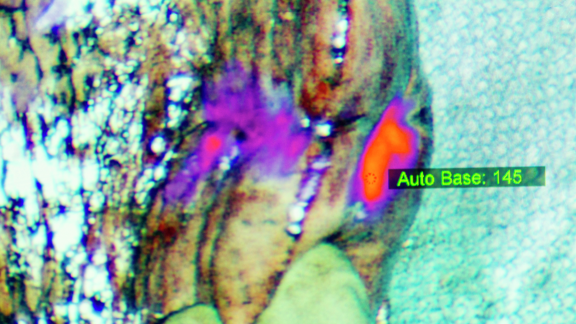 A lung cancer surgery image showing cancerous tissue that glows due to an imaging drug