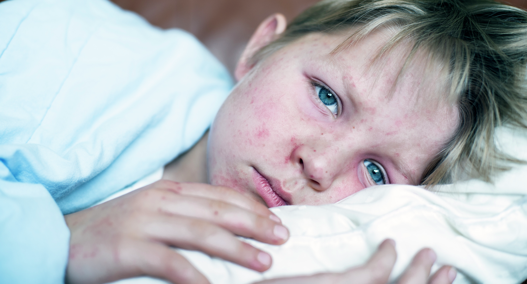 A boy, laying in a bed under a blanket, with a rash on his hands and face caused by a virus.