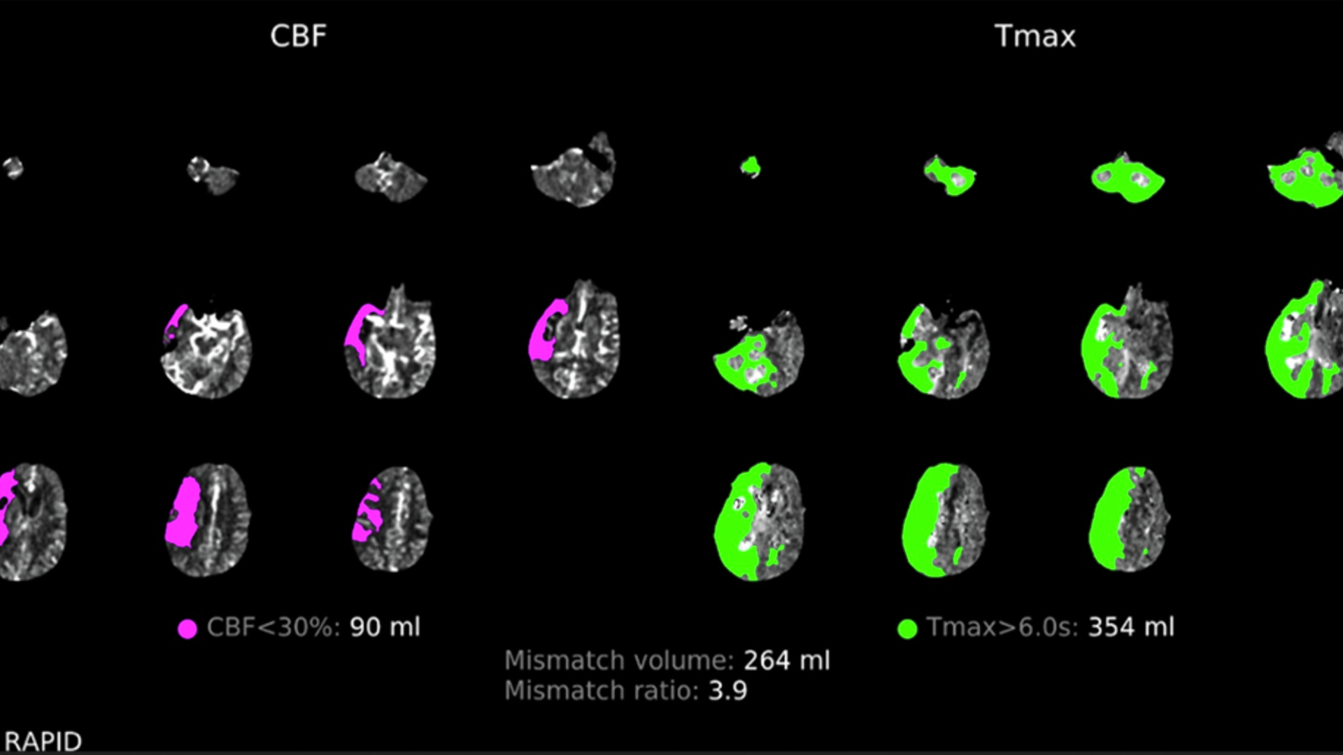 CT perfusion of injured brain core on left in pink, and penumbra (area expected to die if blood flow is not restored) on right in green