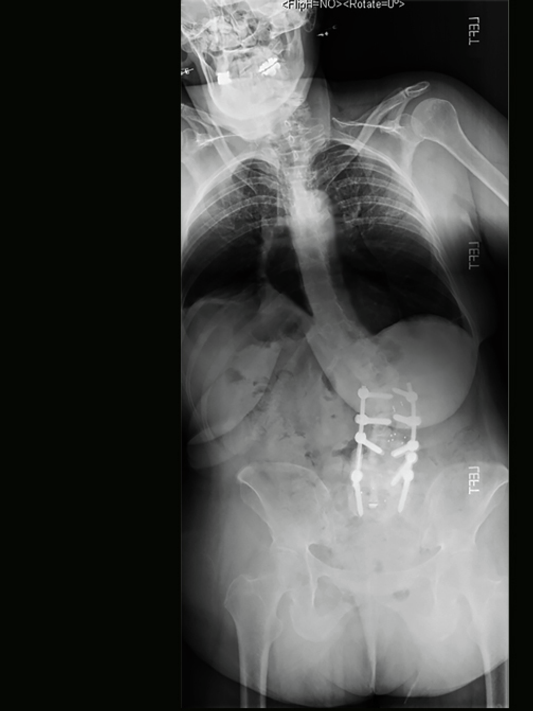 An X-ray shows a woman with a severe curvature of the spine and lower back fusion screws