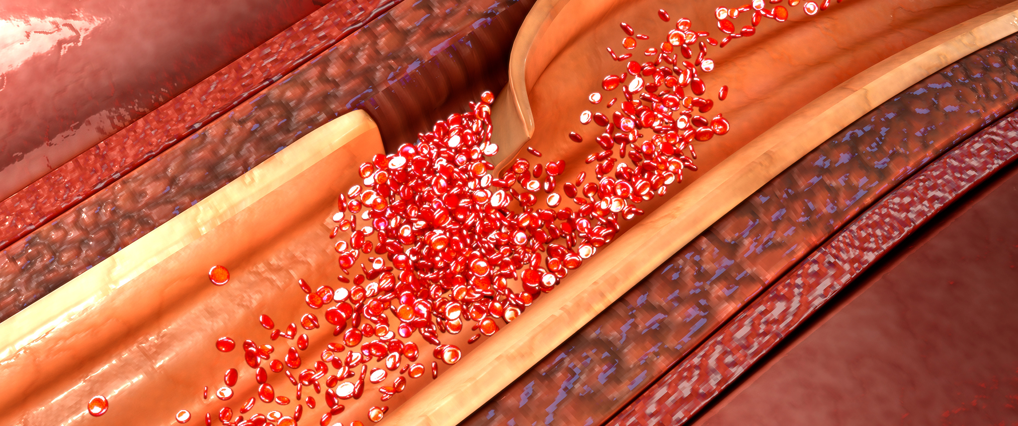 An artist's rendering shows a tear in the interior lumen of the aorta and the resulting escape of blood cells into the aorta lining.