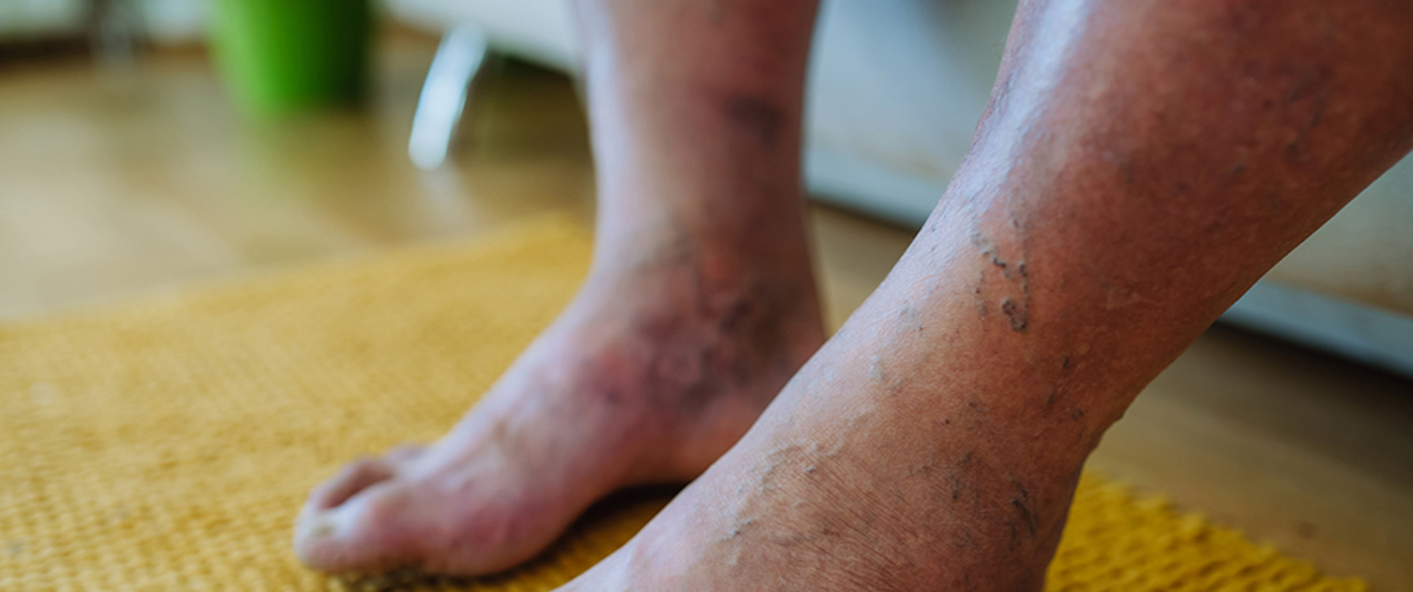 The feet of an individual with PAD are shown