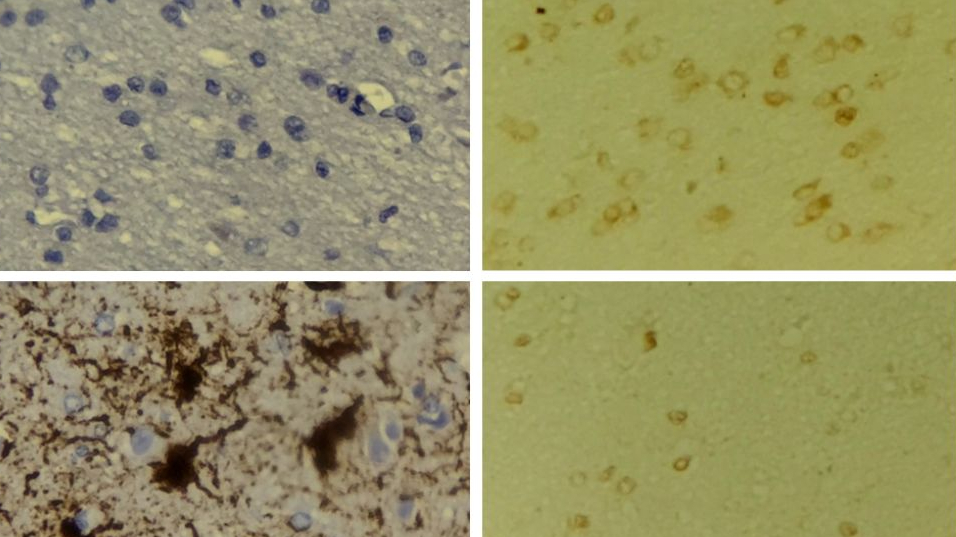 Microscopy images showing healthy brain tissue compared with Alzheimer’s brain tissue. The healthy brain shows mostly clear cells, while the Alzheimer’s brain shows dark, clumped areas. A second set of images shows lighter brown-stained cells in both healthy and Alzheimer’s brains.