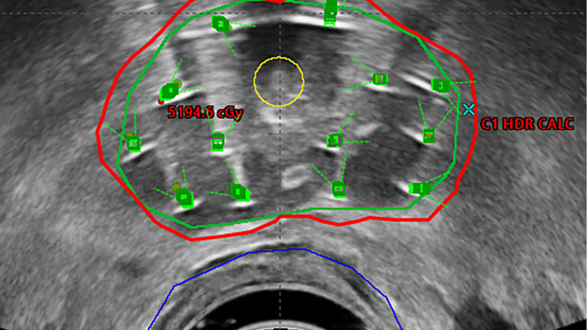 Ultrasound image depicts prostate and surrounding structures with brachytherapy pellet implantation