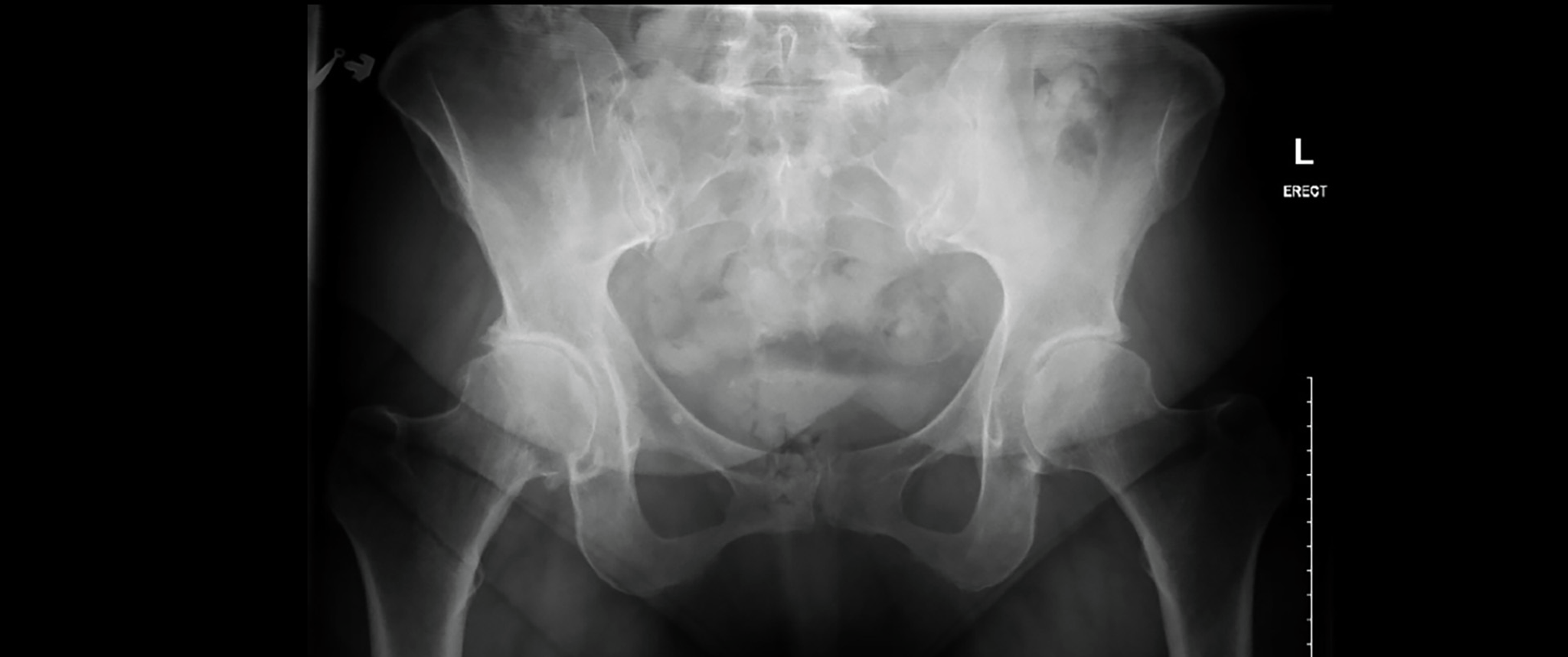 An X-ray representing the pelvic and hip bones of a patient with osteoarthritis of the hip prior to surgery.