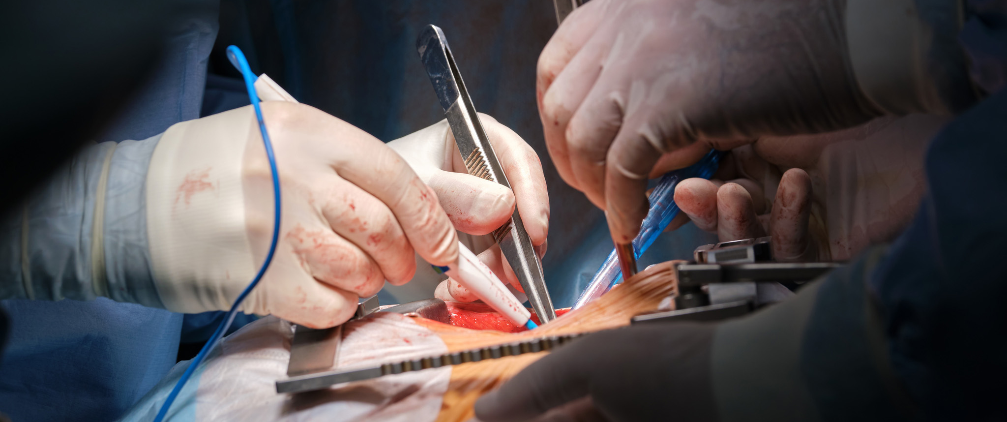 A pair of surgeons' hands are shown holding instruments over a patient's chest during open heart surgery.