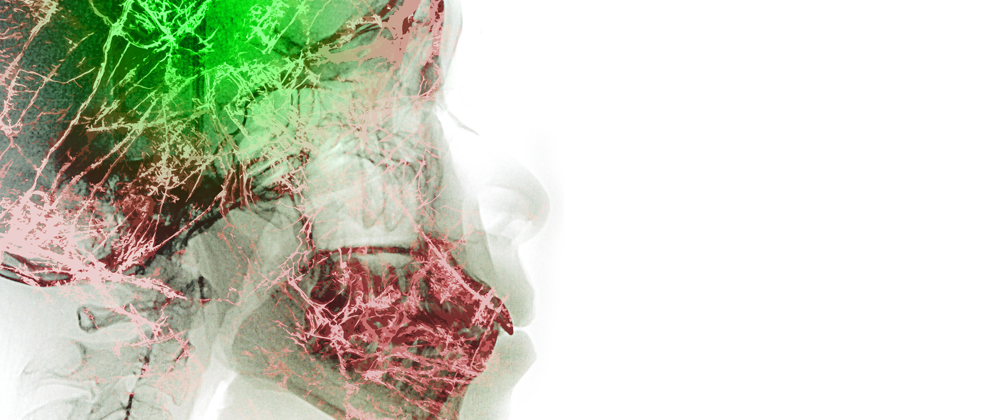 Proton therapy scan of skull