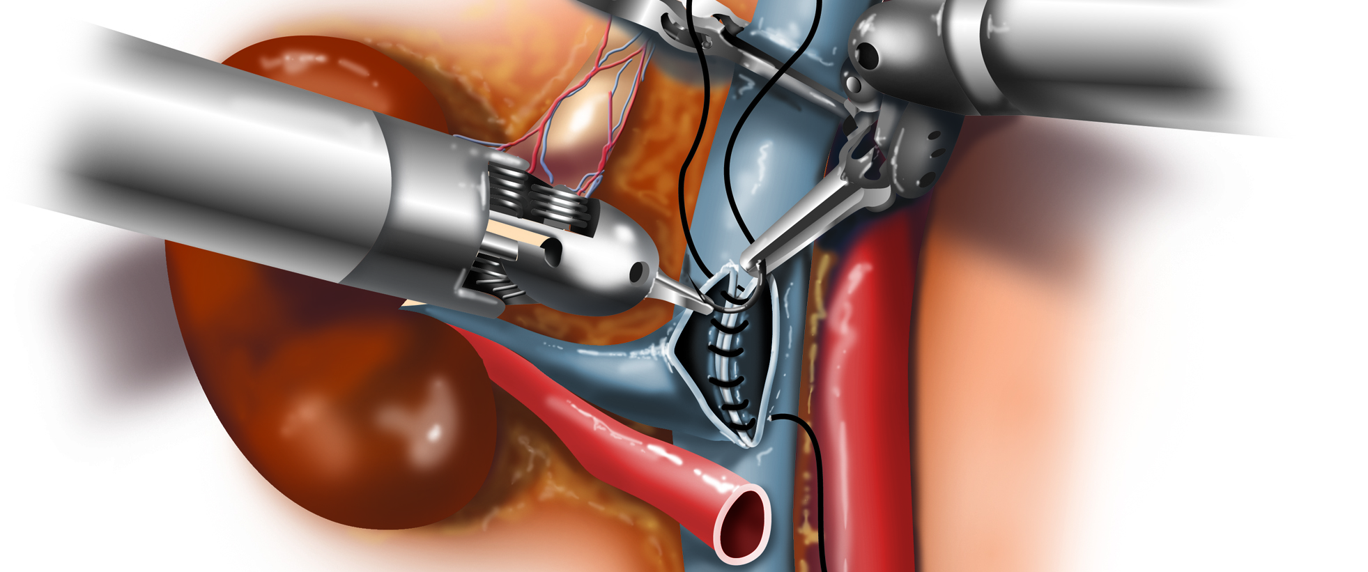 animated robotic instruments suturing the vessels of a kidney in a transplant recipient