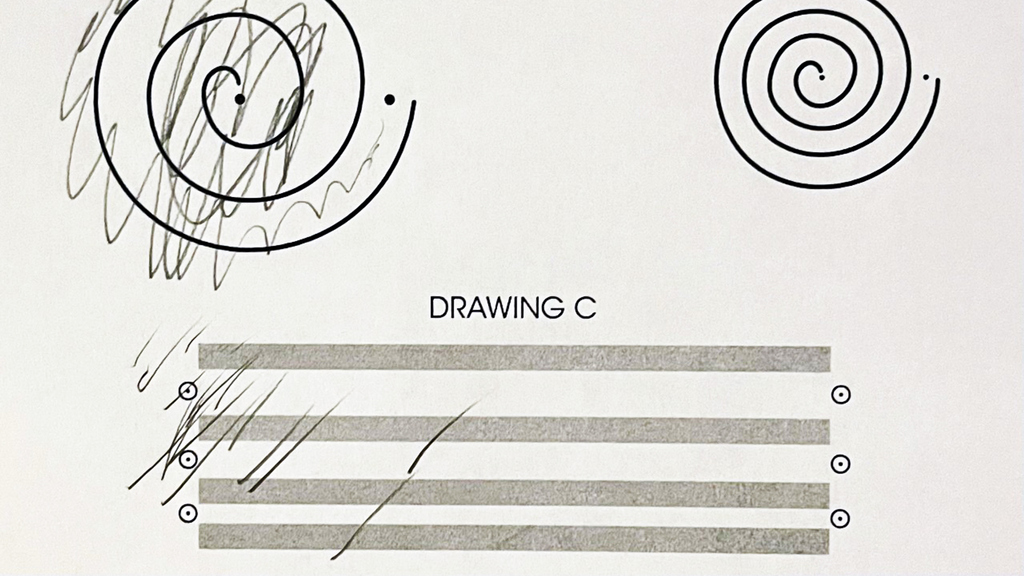 Image of a pre-treatment spiral drawing done by the patient