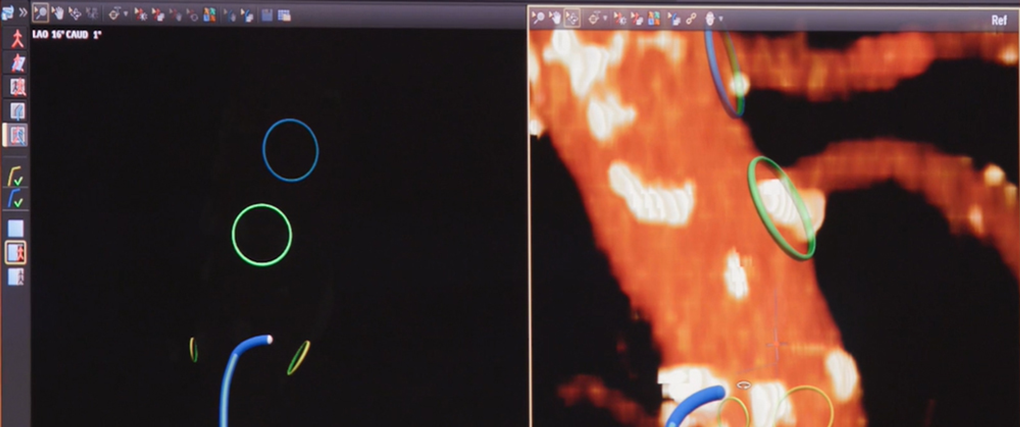 A screen capture of the biplane visualization tools available with the Fiber Optic RealShape system.