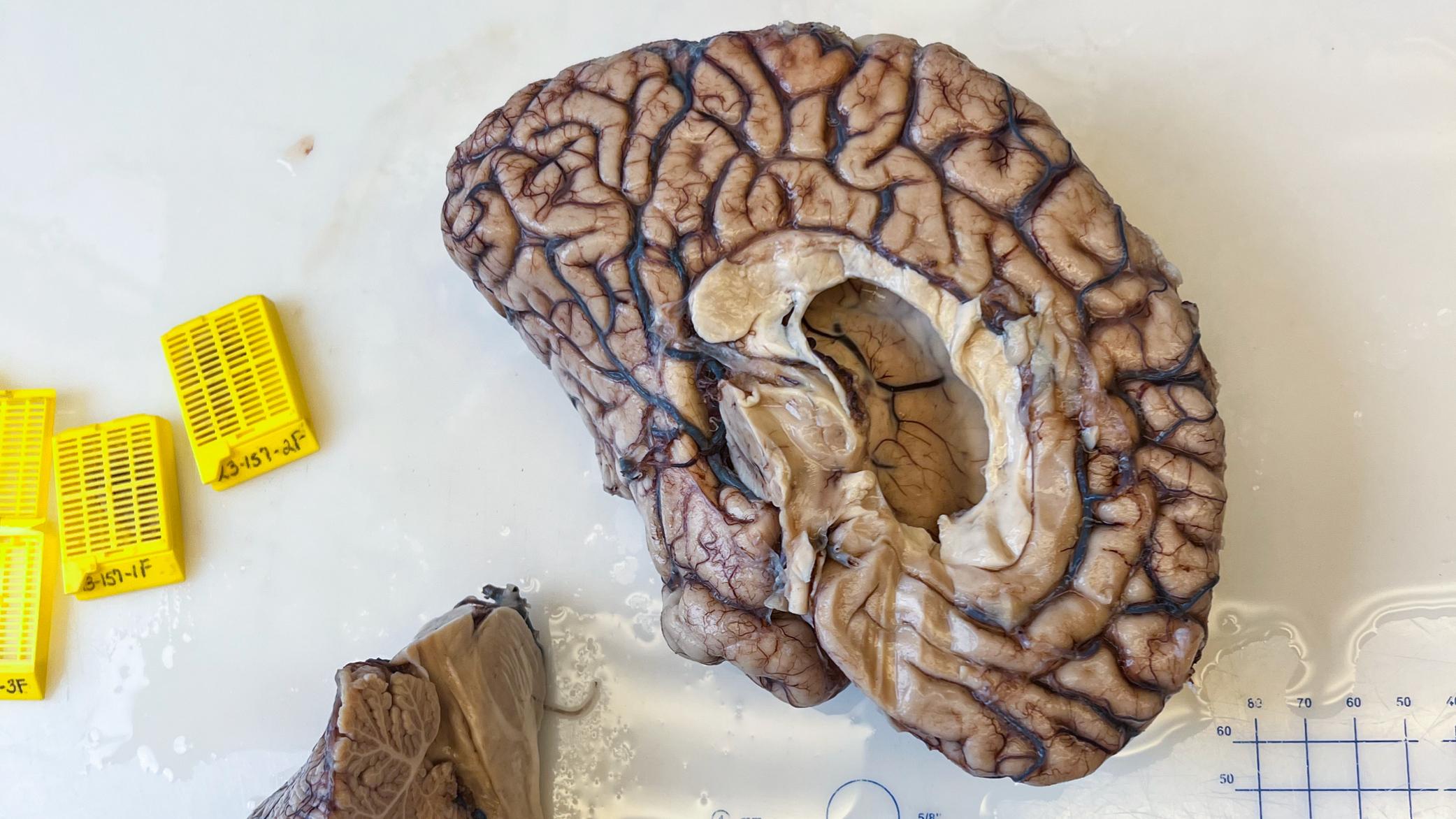 A donated brain specimen on a lab bench