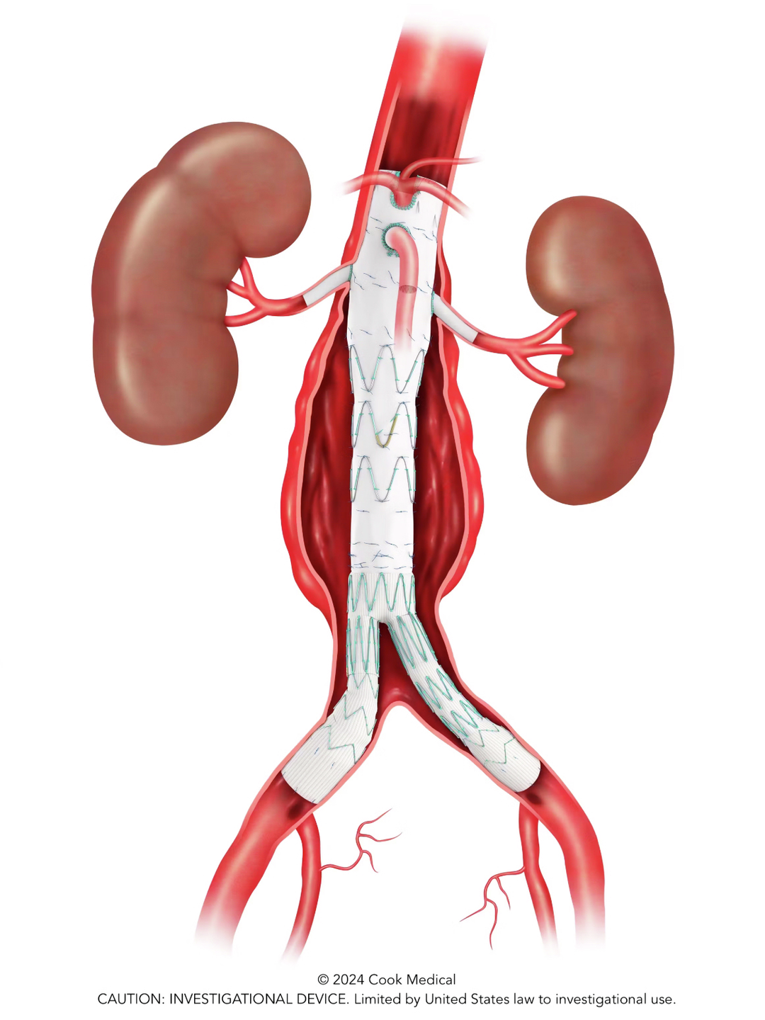 The ZFEN+ stent graft is shown at an aortic aneurysm with fenestrations extending into the renal arteries.