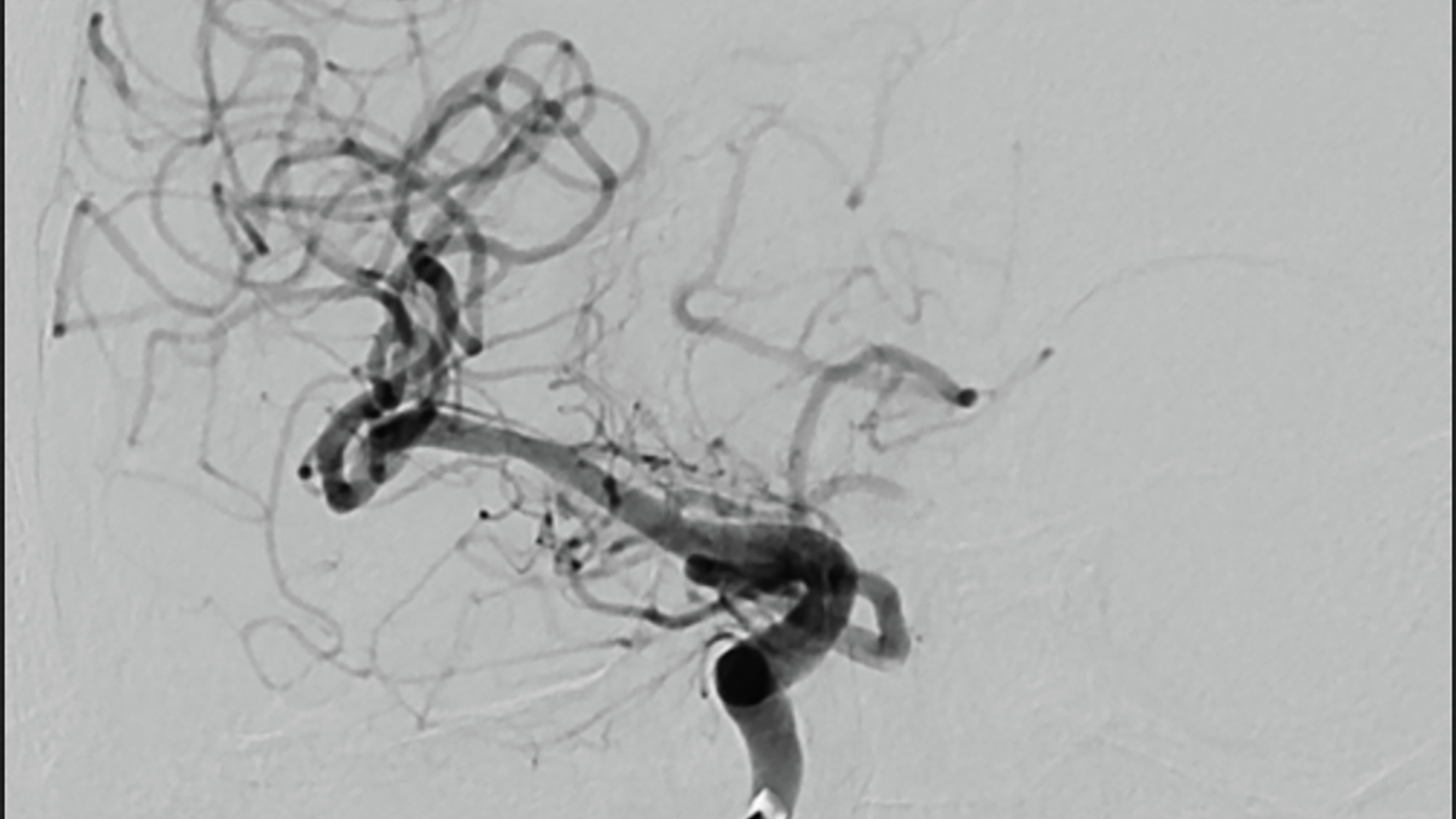 Post-thrombectomy angiogram shows refilling and near complete reperfusion of right middle cerebral artery